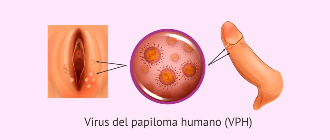 Síntomas del papiloma humano en mujeres: lo que debes saber para actuar