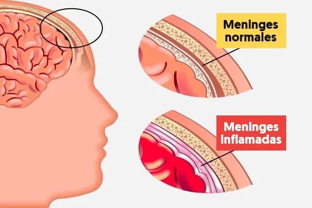 Síntomas de meningitis que no debes ignorar para tu salud
