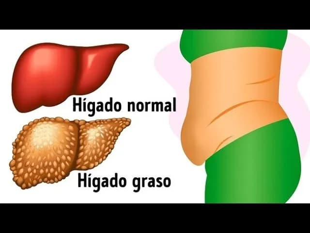 Síntomas del hígado graso: ¿Estás ignorando señales alarmantes?