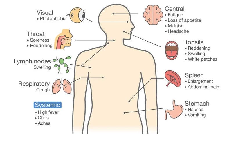 Síntoma de la mononucleosis: identifica los signos y evita complicaciones