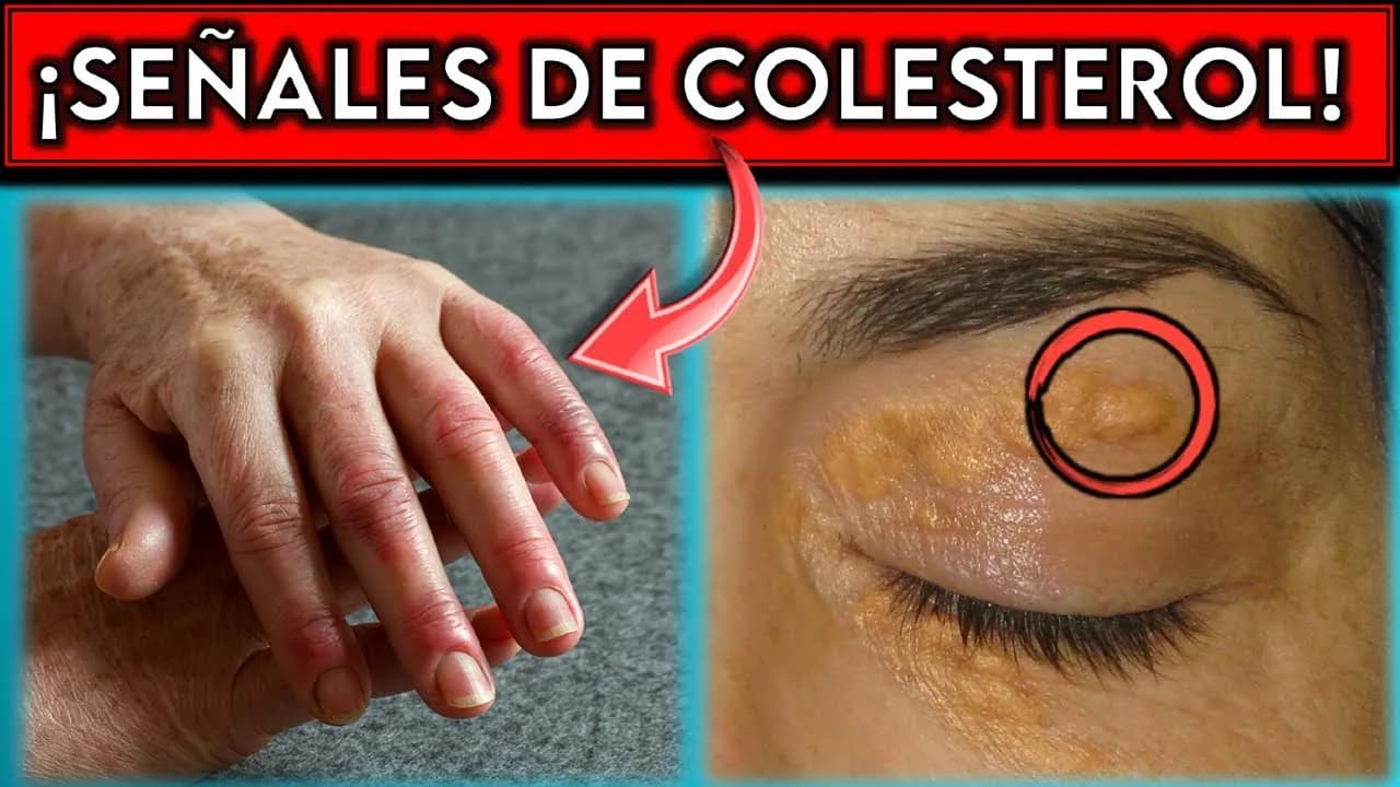 Síntomas de colesterol alto: ¿estás ignorando señales preocupantes?